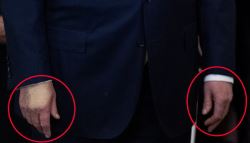 다리 붓고 손등 멍든 트럼프 건강 이상?…백악관 "만성 정맥부전"