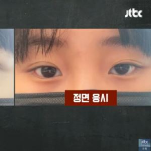 “눈 지방제거 수술 후 ‘사시’ 됐다”…성형외과서 무슨 일이