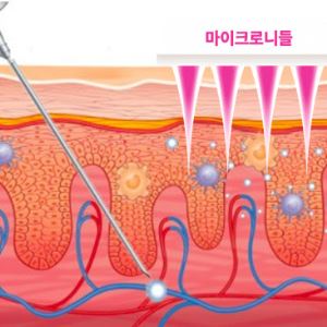 라파스, '붙이는 알레르기 비염약' 임상1상 성공…상용화 청신호