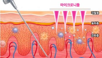 라파스, 세계 첫 마이크로니들 패치 면역치료제 상용화 청신호...다음은?