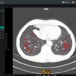 코어라인소프트 "FDA 승인 AI 의료기기 글로벌 톱20 진입"