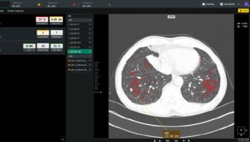 코어라인소프트 "FDA 승인 AI 의료기기 글로벌 톱20 진입"