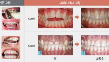 “소아부터 노인까지 시장 무한 확장” 형상기억 투명교정장치[그래피 대해부]②