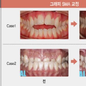 “소아부터 노인까지 시장 무한 확장” 형상기억 투명교정장치[그래피 대해부]②