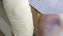 키 190cm·120kg 고교생, 동급생에 '로킥'…전치 6주에도 장난