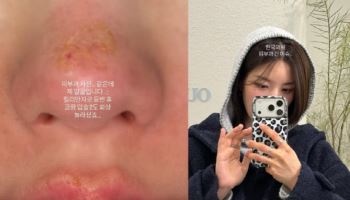 권은비, 킬리만자로 등반 후 2도 화상 "코·입술이…"