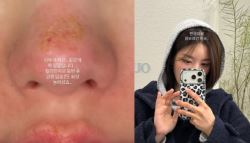 권은비, 킬리만자로 등반 후 2도 화상 코·입술이…