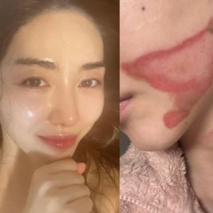 AOA 출신 권민아 "피부과 시술 도중 2도 화상" 피해 호소