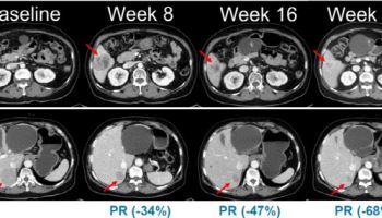 한미약품 "흑색종 신약 ‘벨바라페닙’, 임상 2상 환자 투약 시작"
