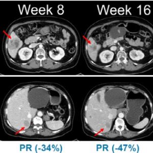 한미약품 "흑색종 신약 ‘벨바라페닙’, 임상 2상 환자 투약 시작"