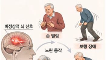 파킨슨병 환자 삶의 질 개선하는 뇌심부 자극술, 왜 주목받나?