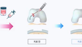 한스바이오메드, 에이템즈 지분 늘리는 이유…‘A-Paste-C’ 가치는