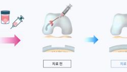 한스바이오메드, 에이템즈 지분 늘리는 이유…‘A-Paste-C’ 가치는