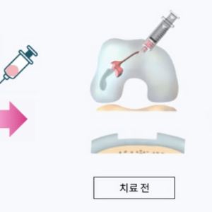 한스바이오메드, 에이템즈 지분 늘리는 이유…‘A-Paste-C’ 가치는