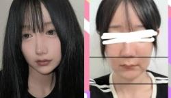 한국서 양악수술 받고 입과 턱 마비됐다…日인플루언서 호소